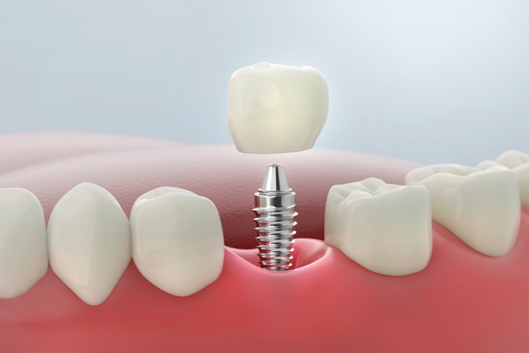 Same Day Fixed Teeth with Dental Implants