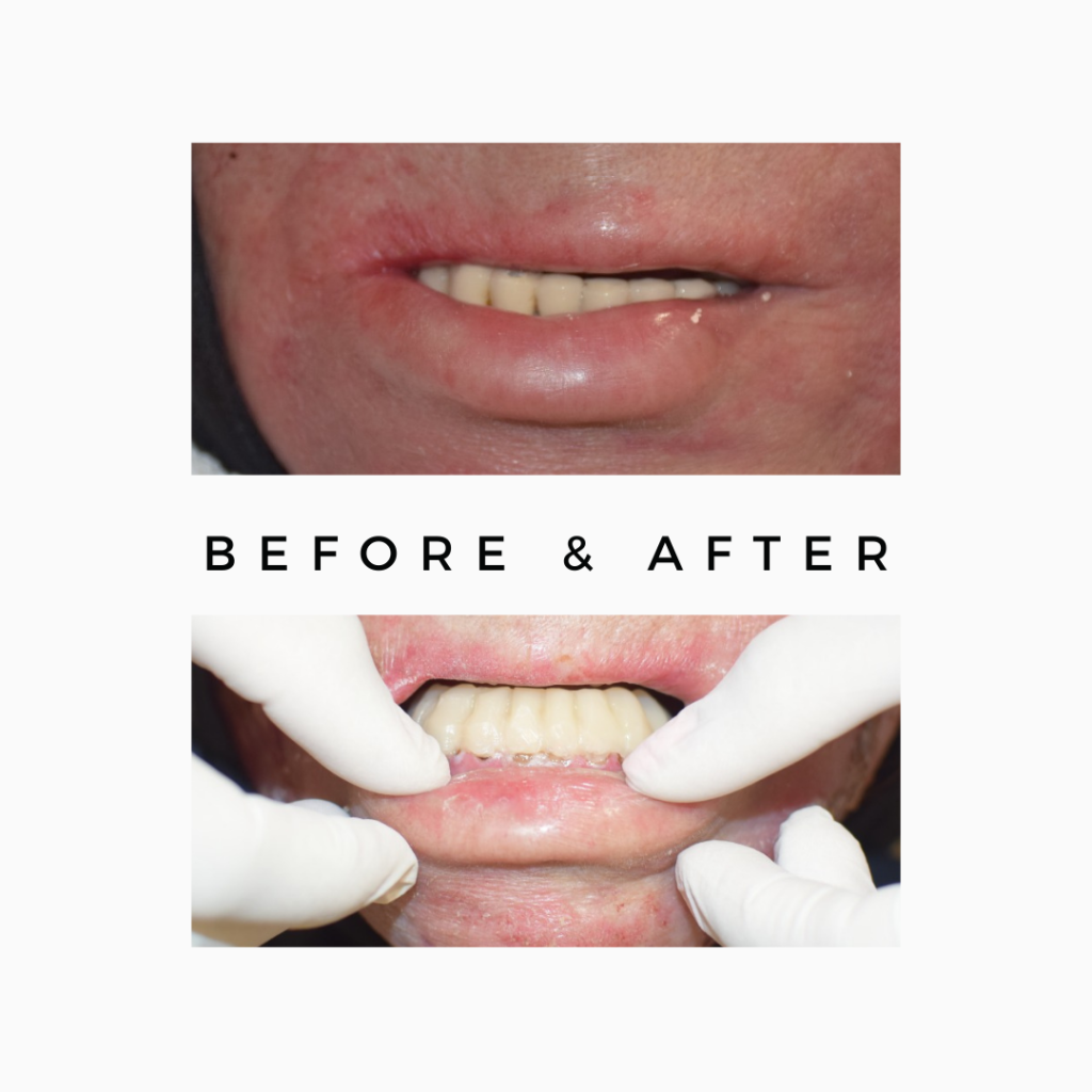 Oral Cancer Rehabilitation with teeth