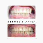 Before After Teeth