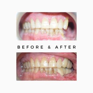 Before After Teeth