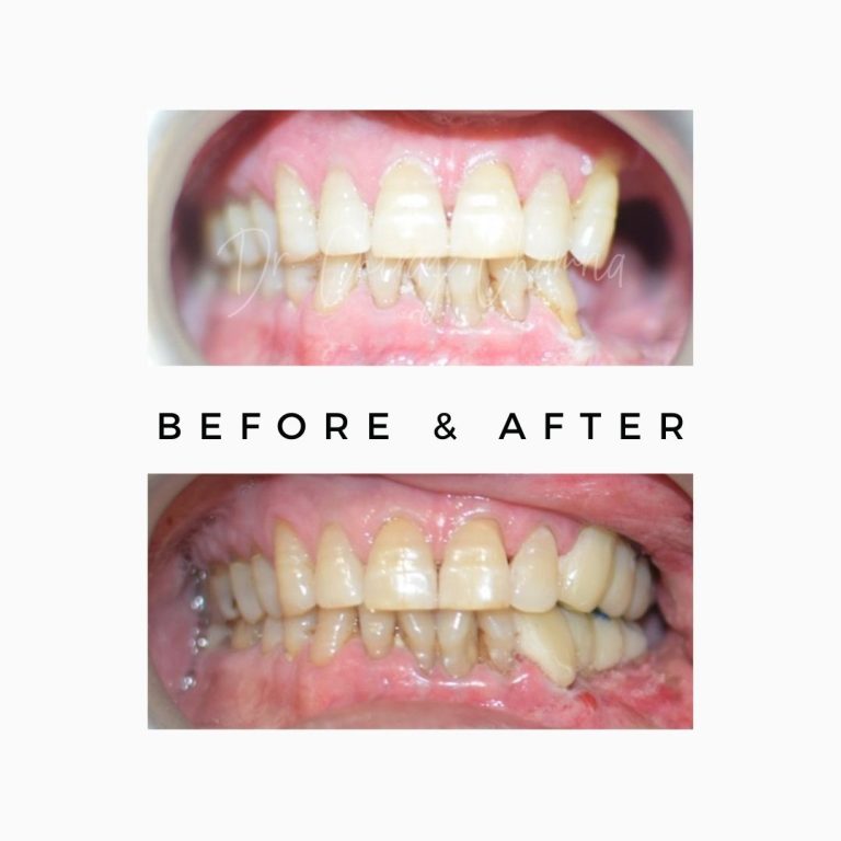 Before After Teeth