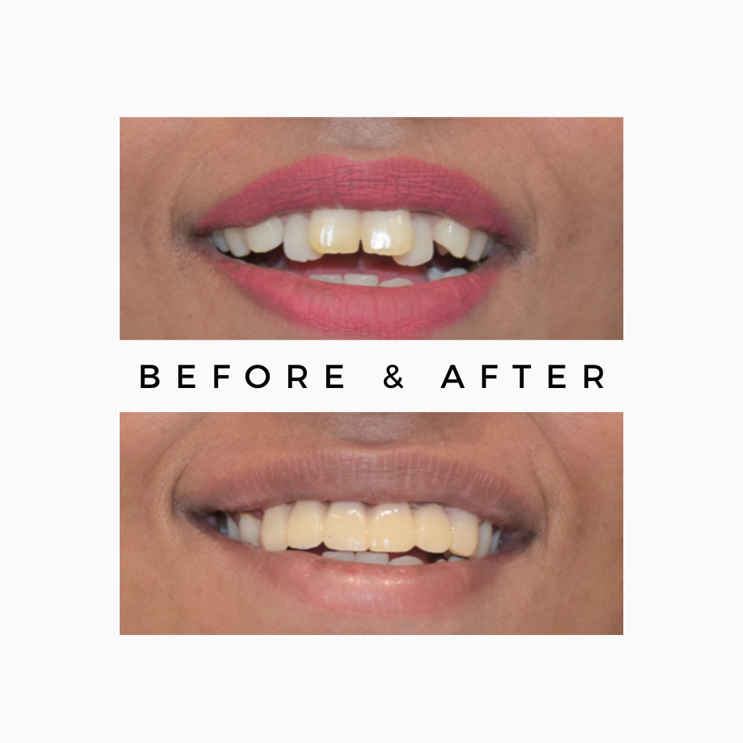 Smile Makeover