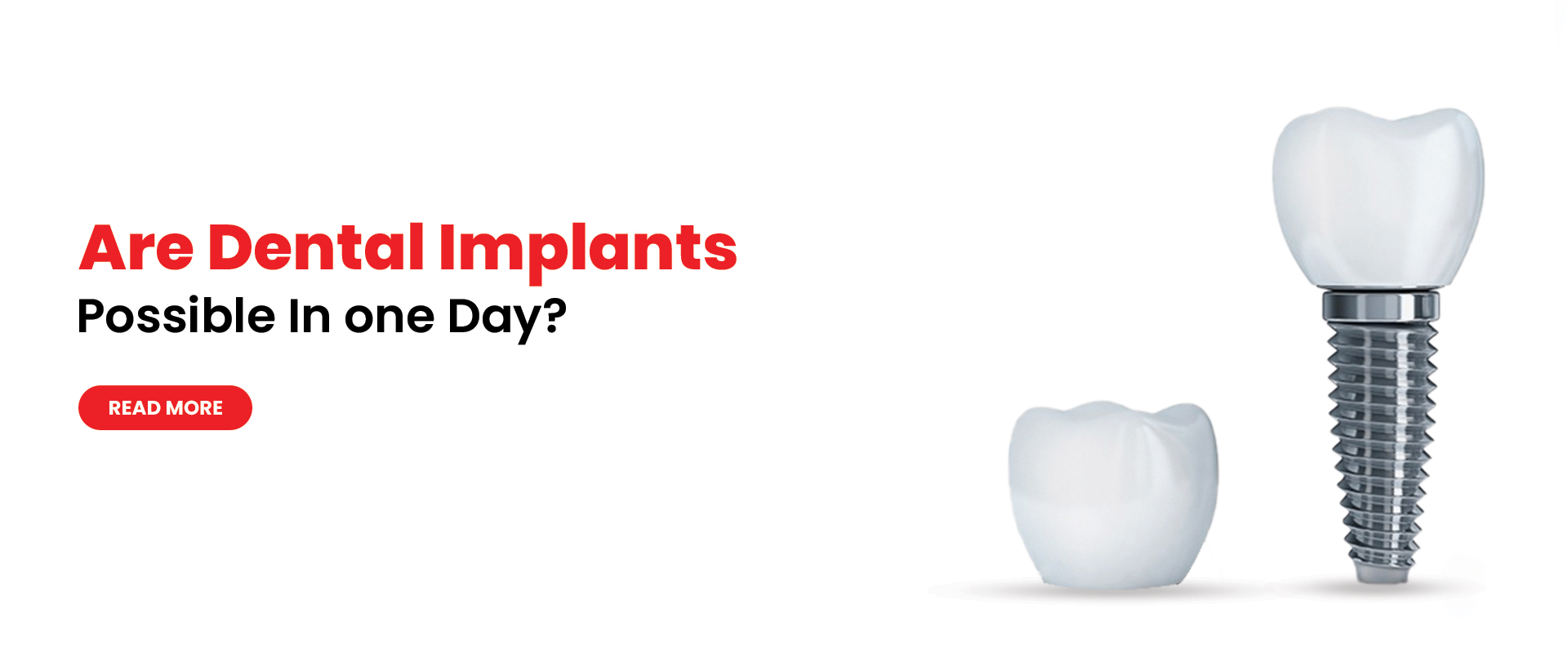 Missing Teeth Dental Implants Treatment