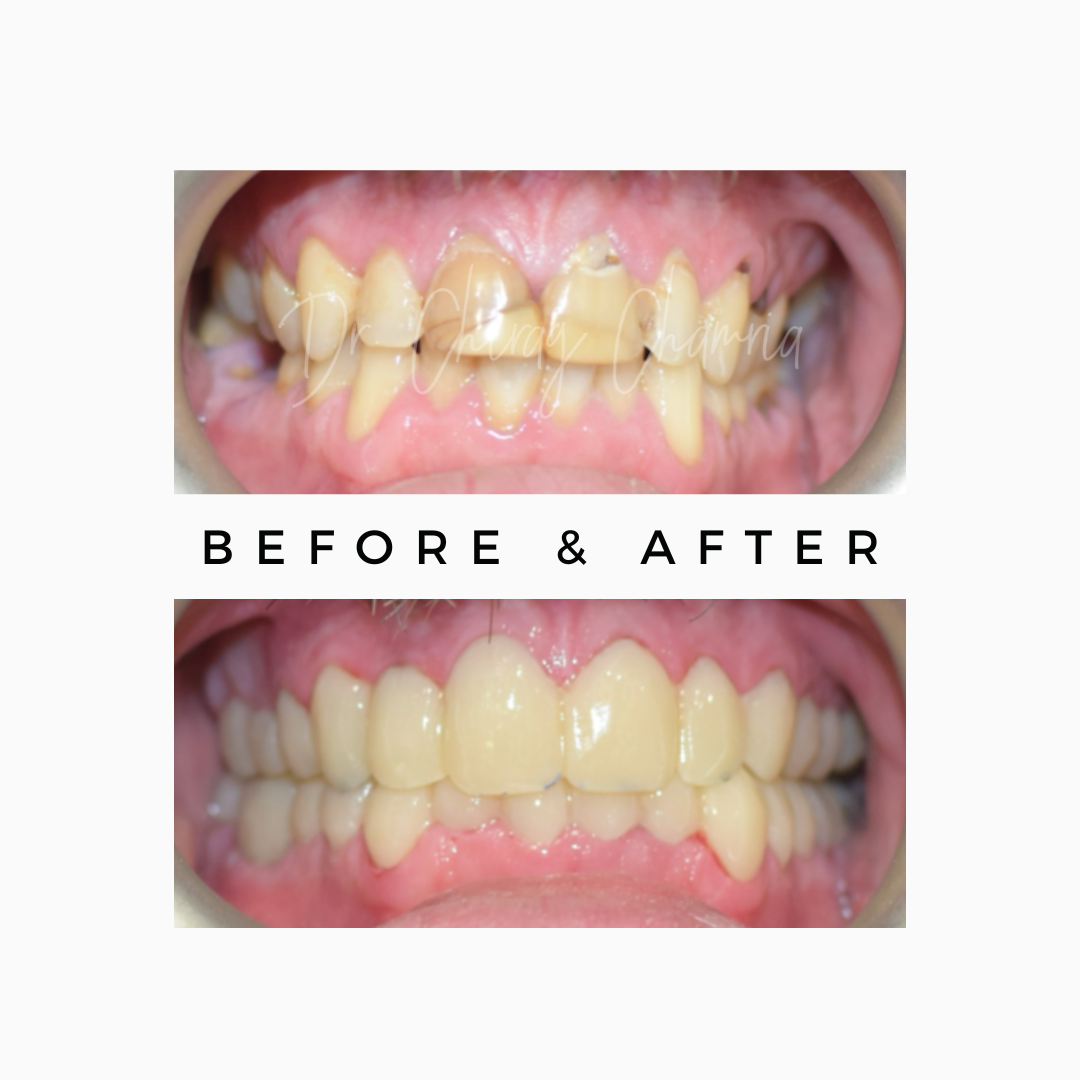 Full Mouth Makeover
