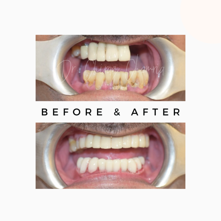Full Mouth Makeover