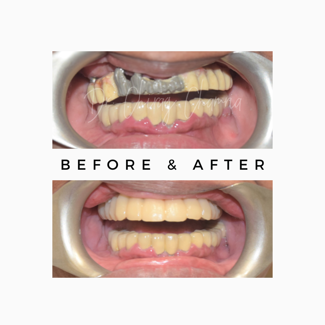Upper Lower Teeth Rehabilitation
