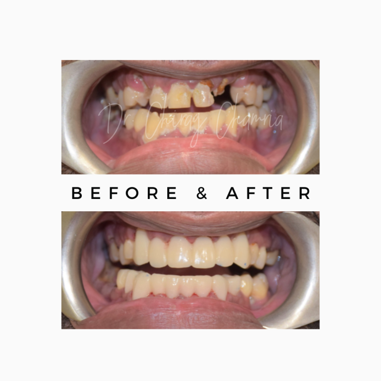 Missing Teeth