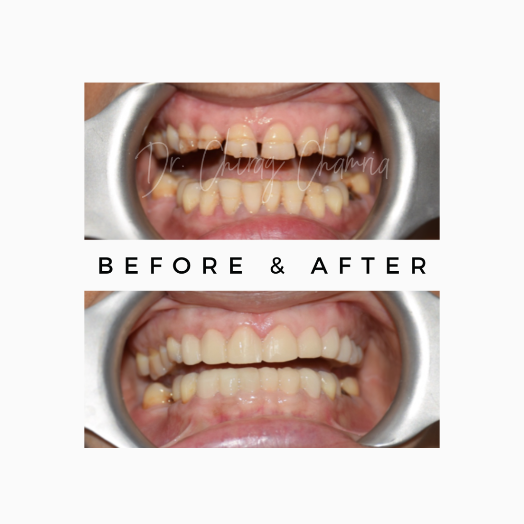 Full Mouth Dental Bridge