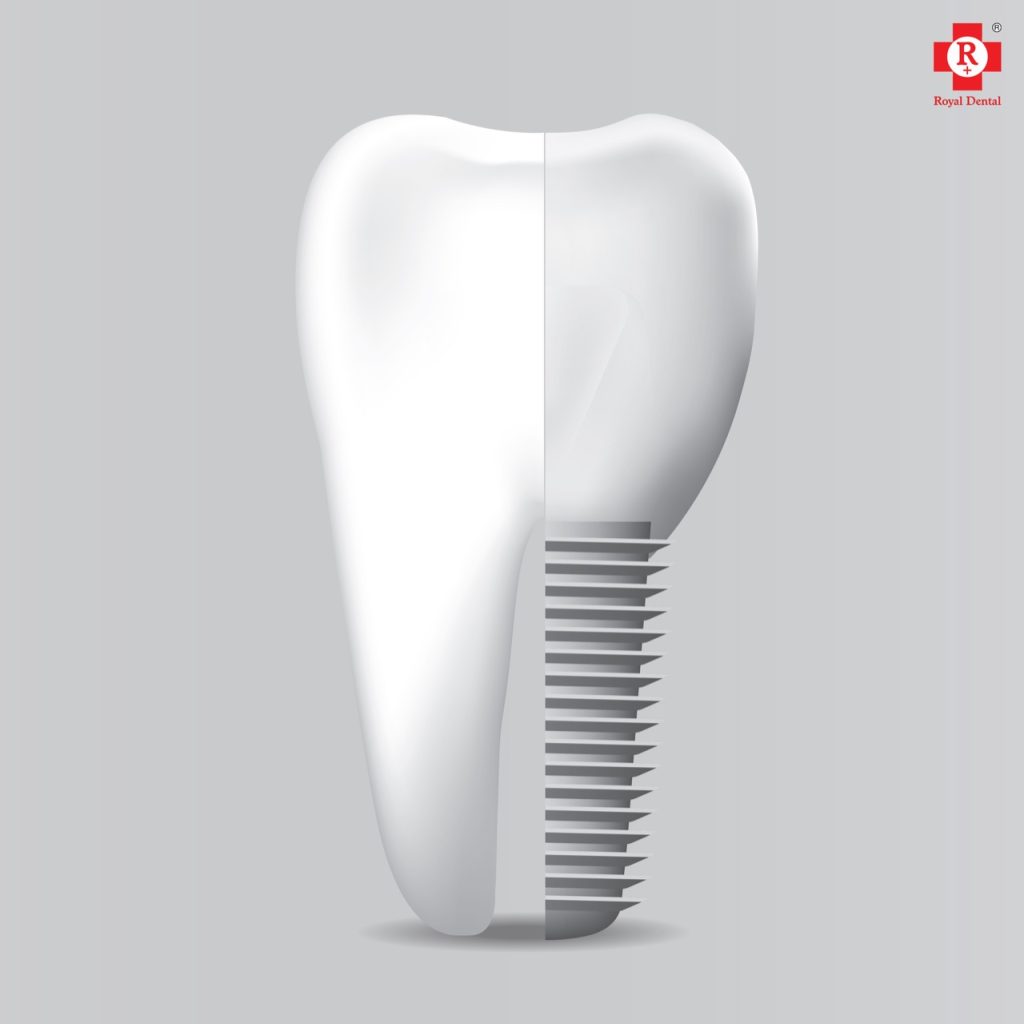 Dental Implants