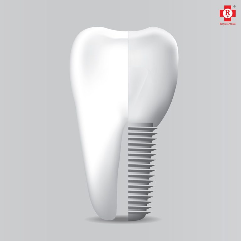 Dental Implants