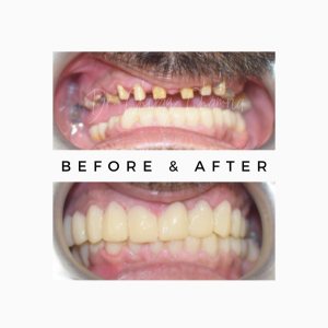 Multiple Small Teeth Fixing