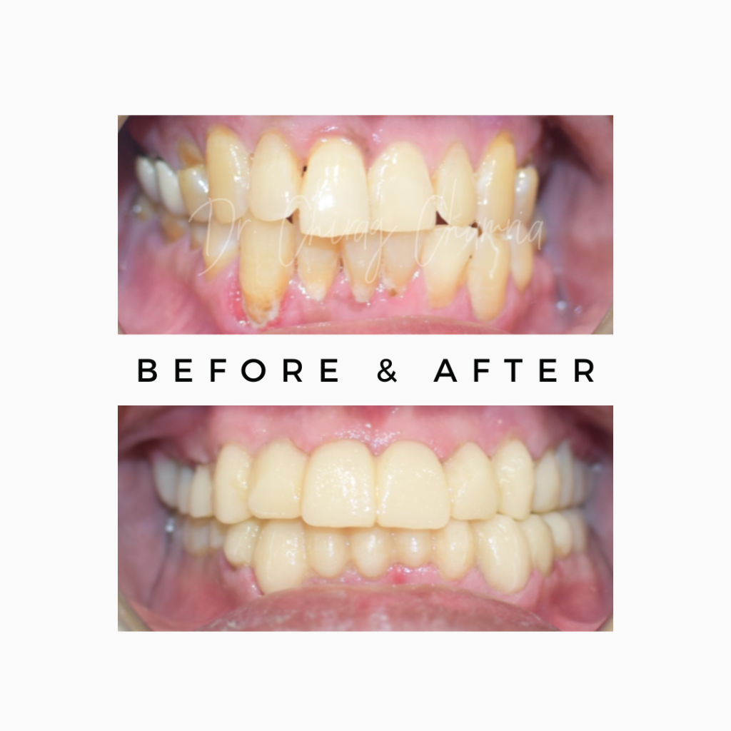 Crooked Teeth Correction