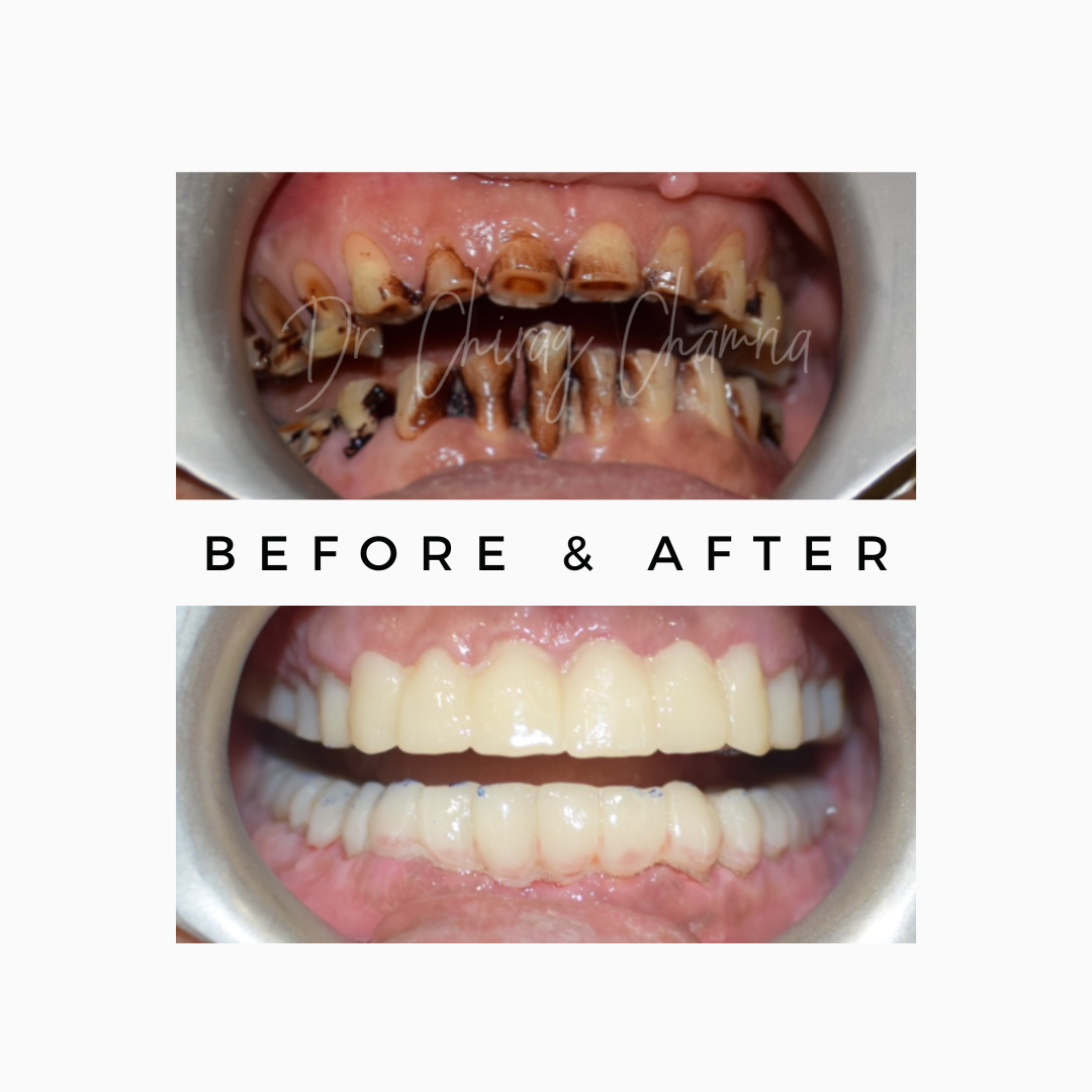 Teeth Stains Treatment