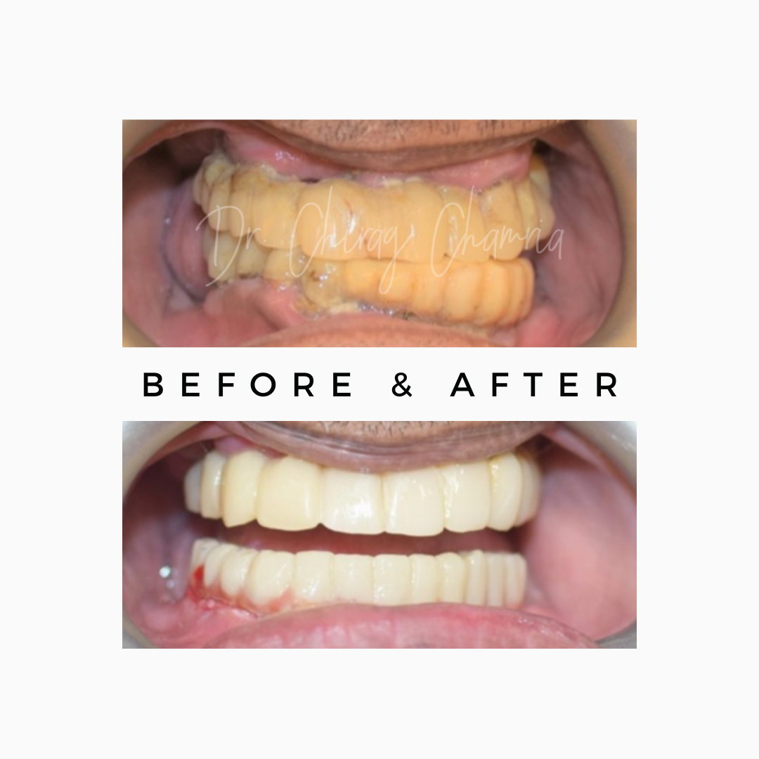 Missing Teeth Upgradations
