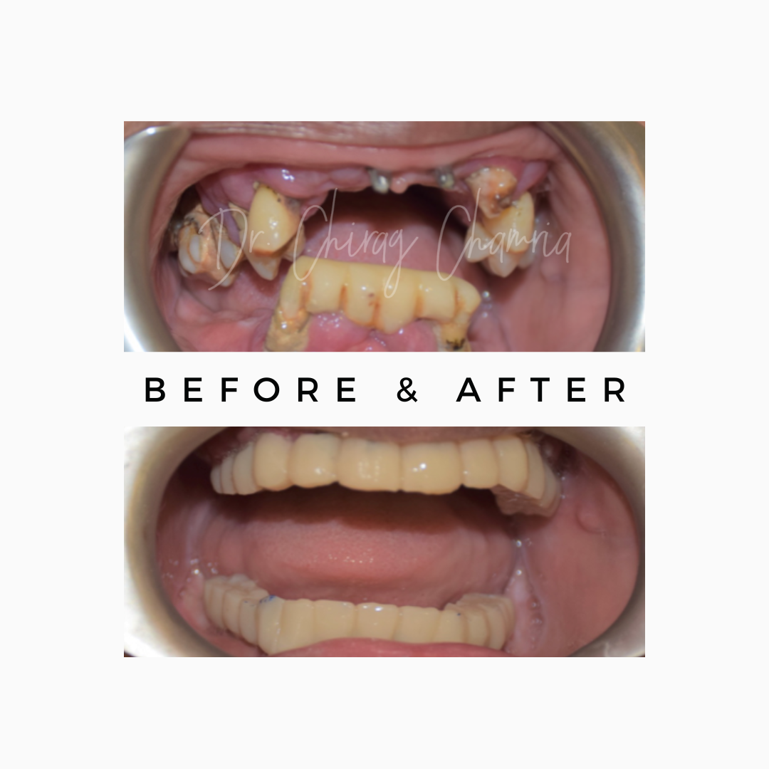 Full mOuth Rehabilitation