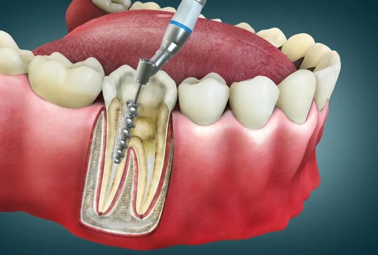 Root Canal Treatment In Jaipur For Tooth Pain Relief