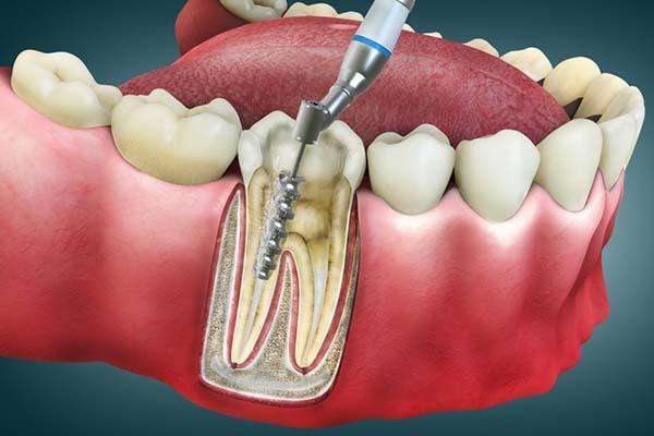 Root Canal & Tooth Mobility