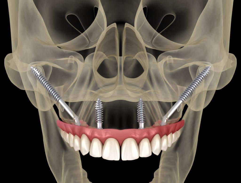 Dental Implant