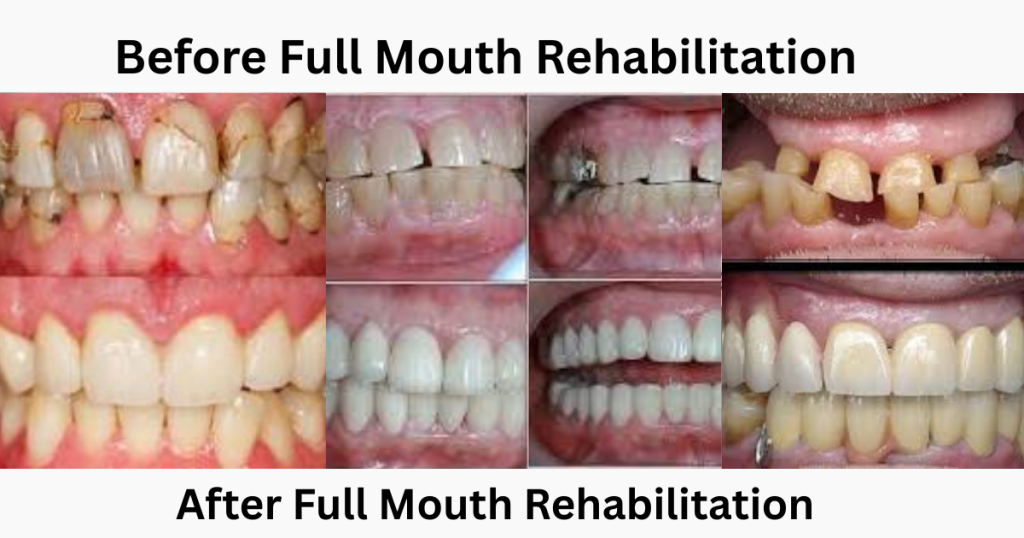 Full Mouth Rehabilitation