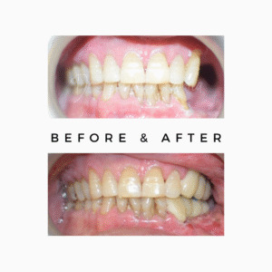 Fixed-Teeth-after-Oral-Cancer-300x300