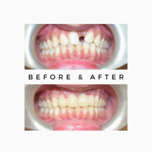 Front-Missing-Teeth-300x300