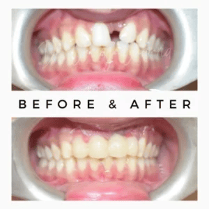 Front-Single-Tooth-Implant-Result-300x300