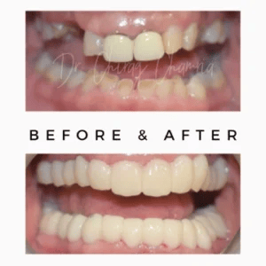 Full-Mouth-Smile-Result-300x300-4