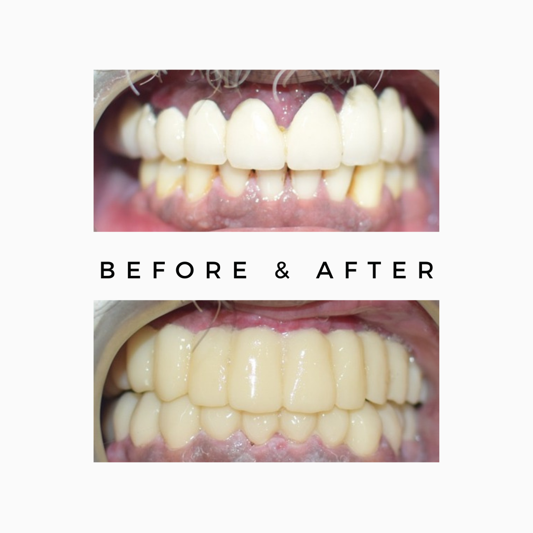 Replacement Of ceramic Bridge