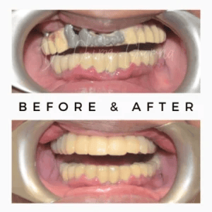 SAPTeeth-Dental-Crown-Before-and-After-300x300