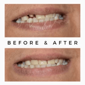 Single-Tooth-Fixing-Result-300x300