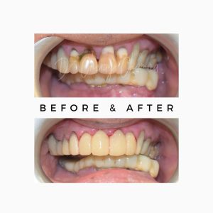 Oral Cancer Rehabilitation