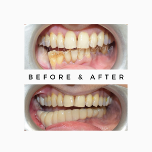 Before after CajTeeth