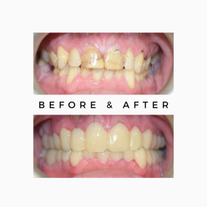 Before After Smile-Makeover