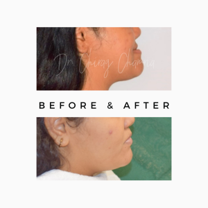 Jaw Correction Surgery