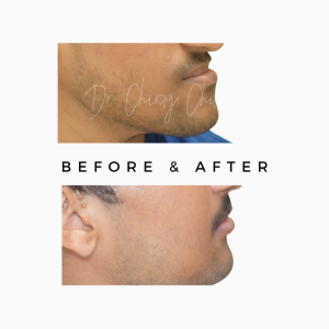 Jaw Trauma Correction Surgery