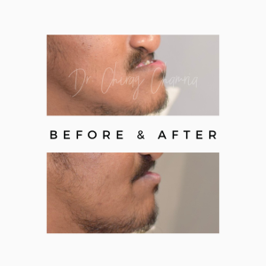Lower Jaw Surgery