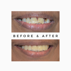 Teeth Protrusion
