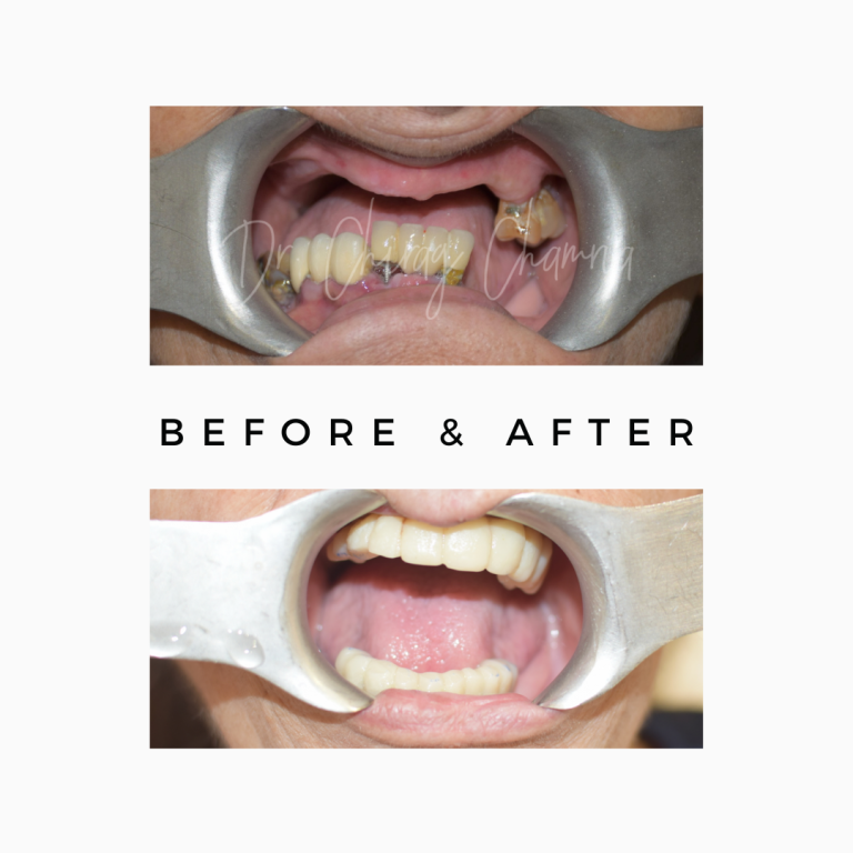 Zygomatic Dental Implants