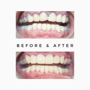 Zygomatic Dental Implants Treatment