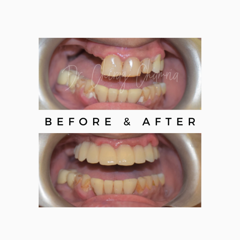 Dental Implants in Jaipur