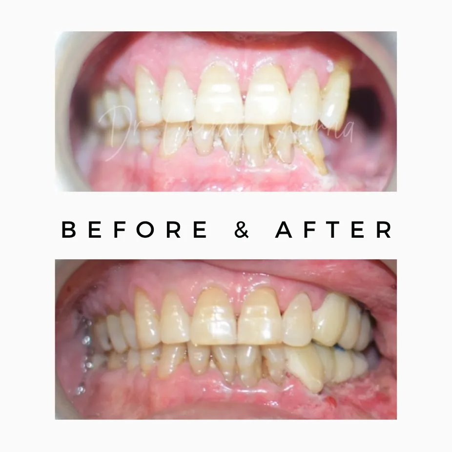 After oral cancer treatment
