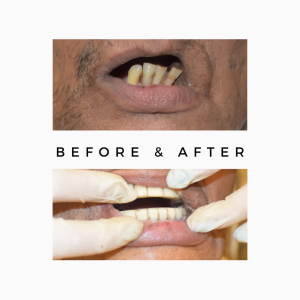 Before & After Tooth Result
