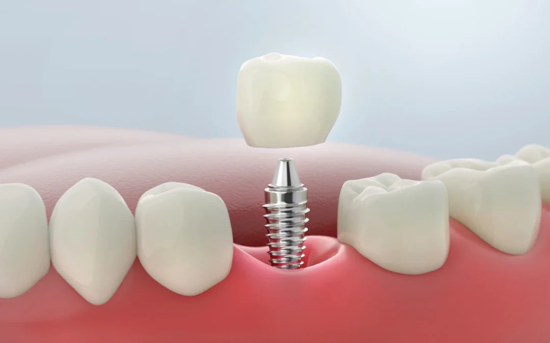 Dental Bridge vs Implant: Which Is Better for Missing Teeth?