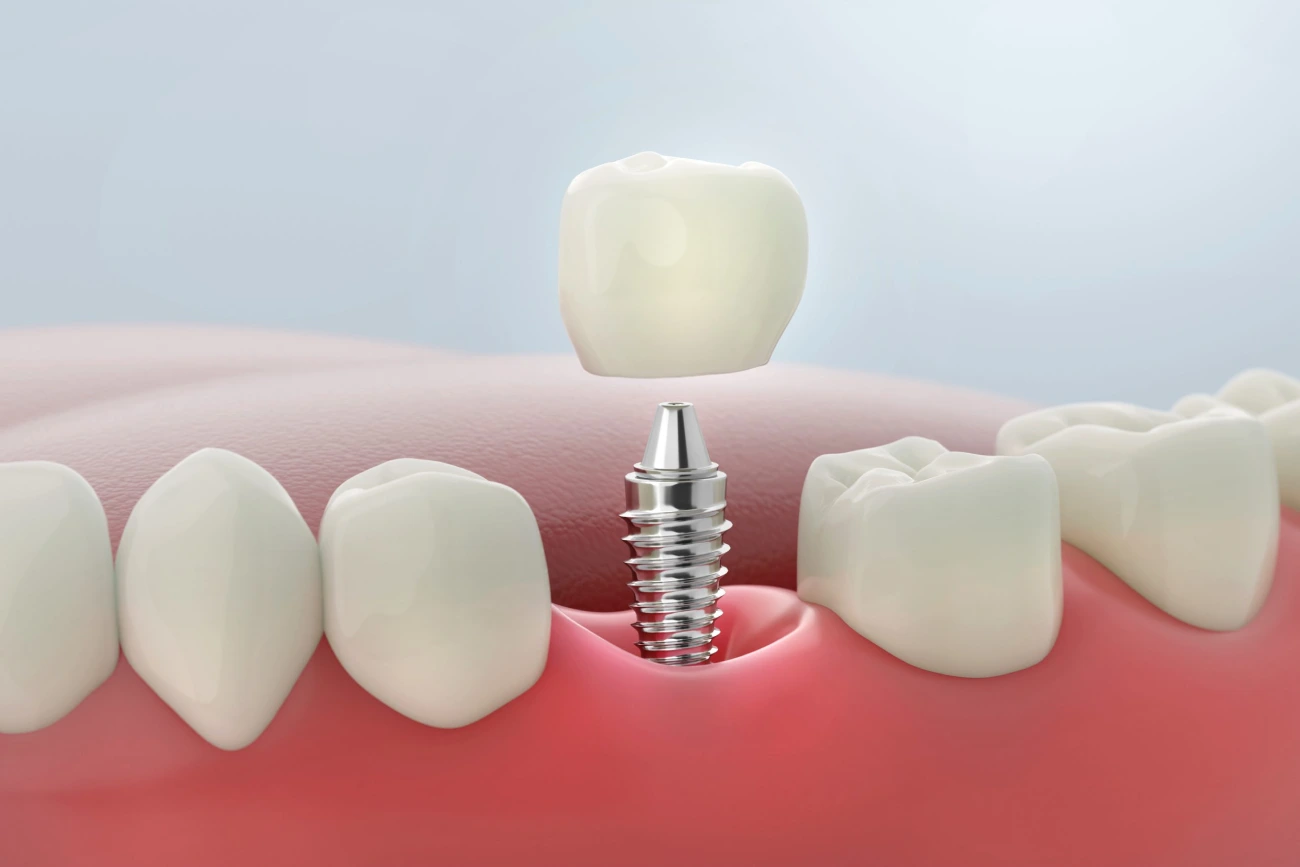 Dental Implants in Jaipur - Permanent Same Day Fixed Teeth Royal Dental Hospital