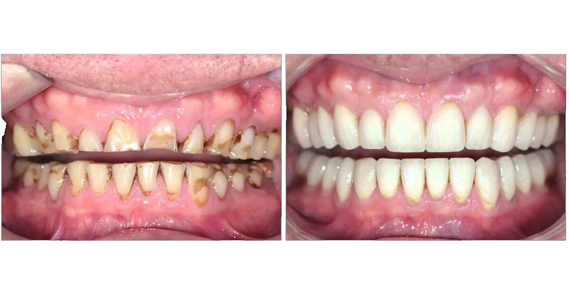 denture before and after Denture before and after