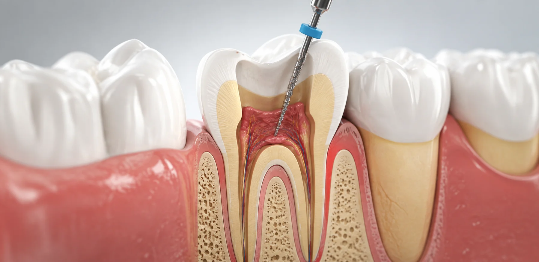 root canal process
