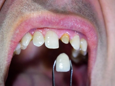 Broken Teeth