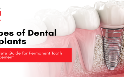 Types of Dental Implants – Complete Guide for Permanent Tooth Replacement