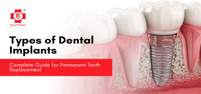 Types of Dental Implants – Complete Guide for Permanent Tooth Replacement