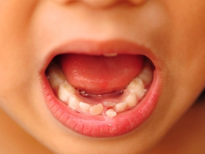 Loose Teeth